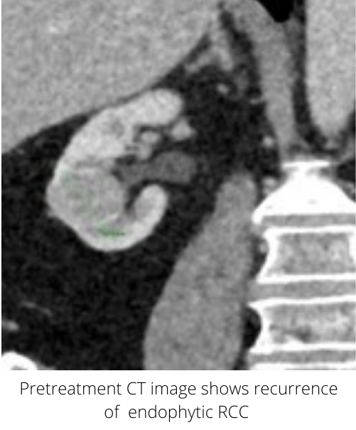 Recurrence of renal cell carcinoma treated with microwave ablation